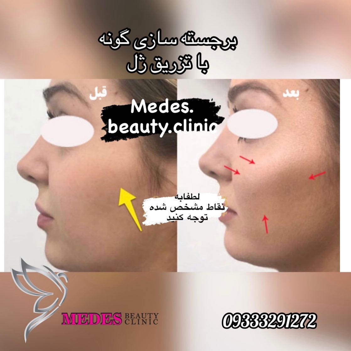 گالری زاویه سازی صورت